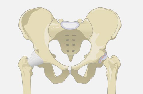 orthopedic Surgery - hip